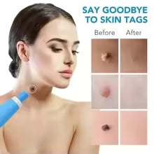 Adult Skin Tag Mole Wart Remover